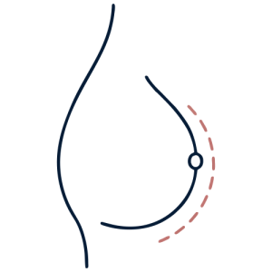 Breast Augmentation - Breast Plastic Surgery