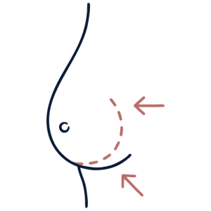 Breast Reduction - Breast Surgery