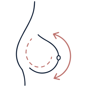 Breast Surgery - Breast Implant Revision