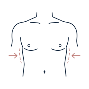 Breast Surgery - Male Breast Reduction