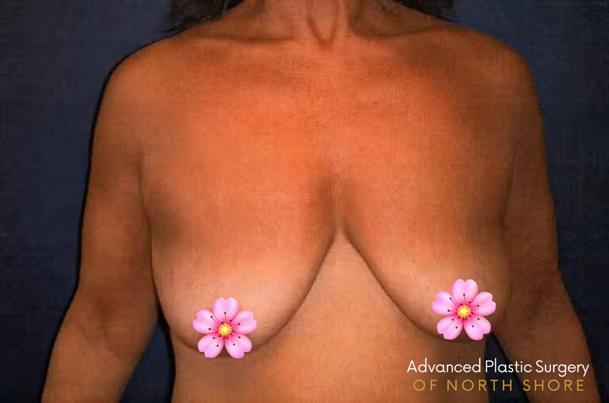 Breast Augmentation Long Island - Before