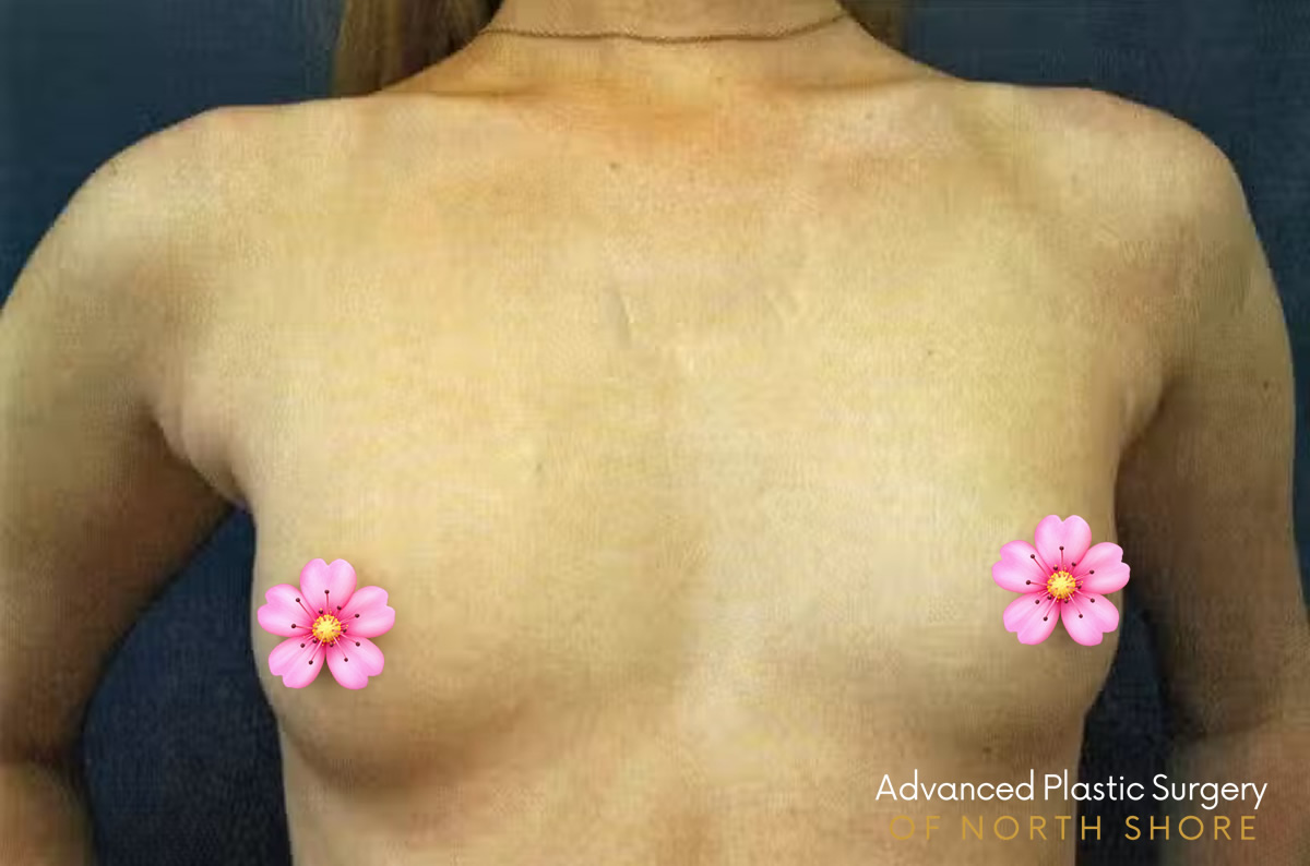 Breast Augmentation Manhattan NYC before